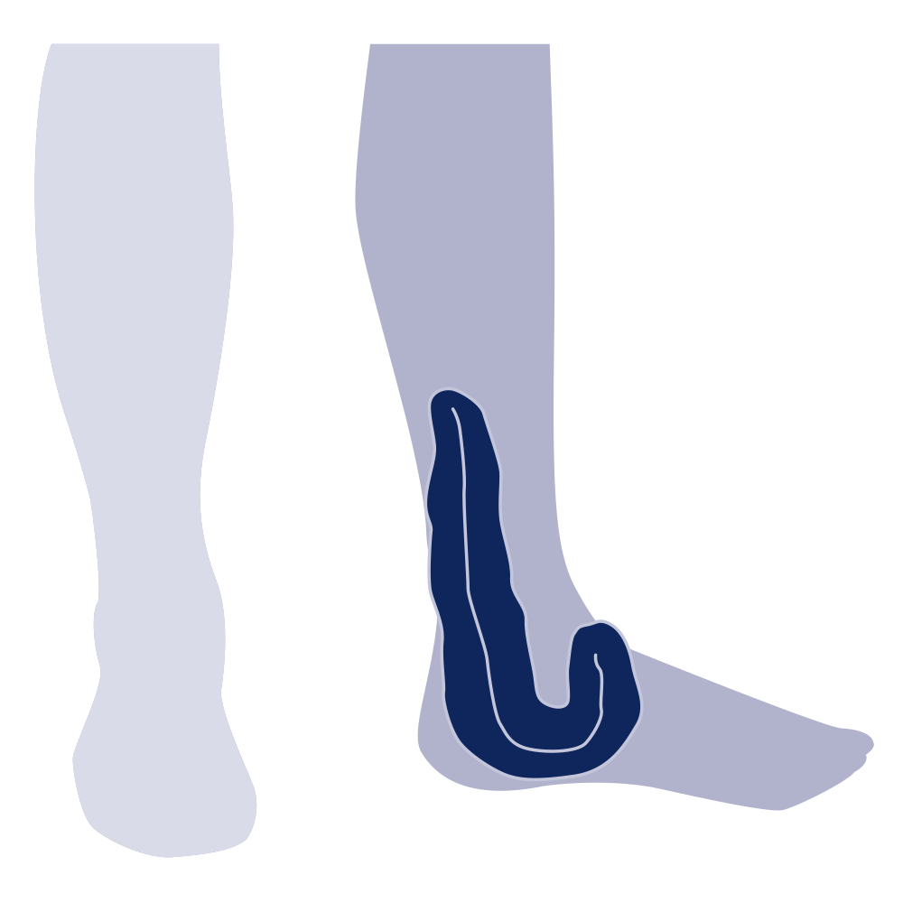 Malleolus Pad
